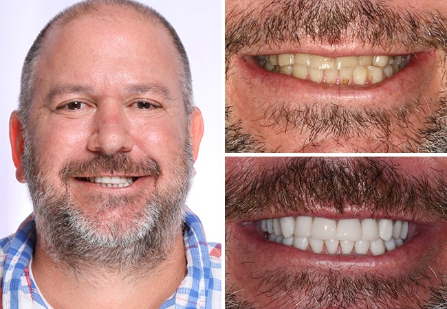 The before and after of a patient who did a full mouth restoration