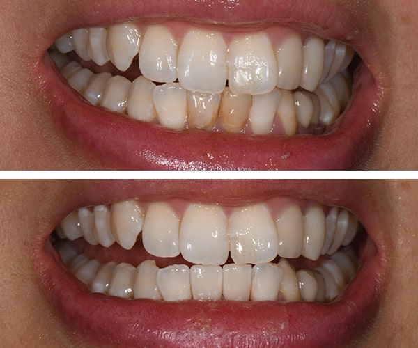The before and after of the smile of patient 4