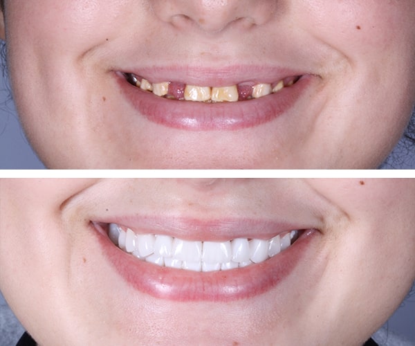 The before and after of the smile of patient 5