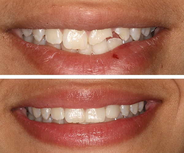 The before and after of the smile of patient 6
