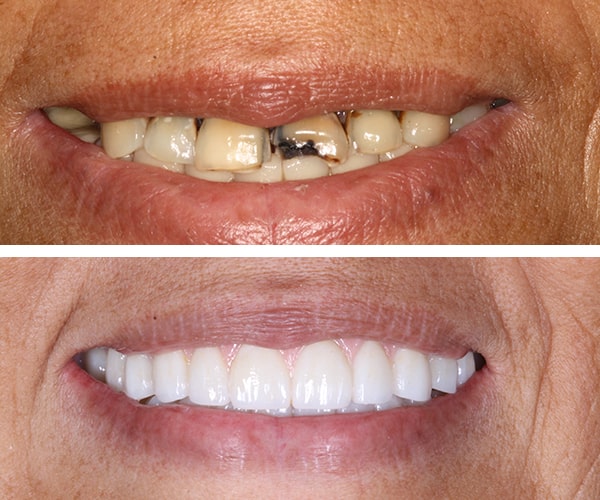 The before and after of the smile of patient 7
