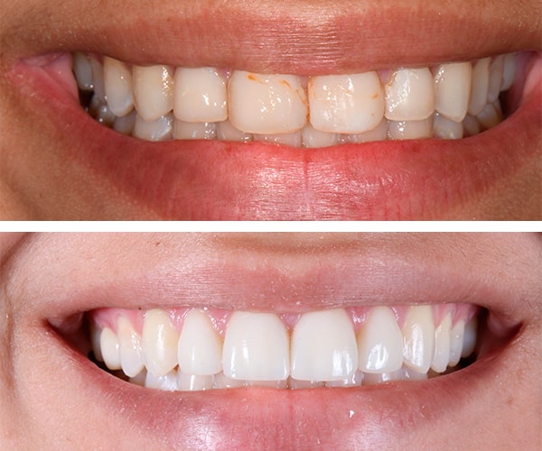 The before and after of the smile of patient