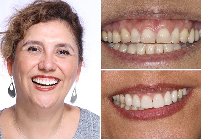 The before and after of a woman who completed her porcelain veneers treatment